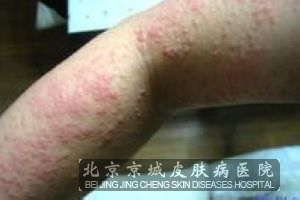 慢性荨麻疹治疗方法