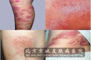 浅谈荨麻疹的病因有什么