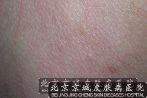 特应性皮炎的基本治疗原则