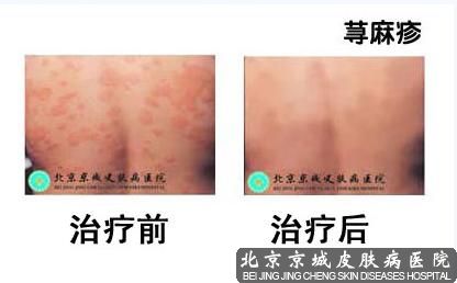荨麻疹效果治疗图