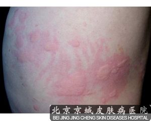 荨麻疹患者饮食需注意事项 