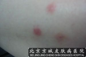 荨麻疹较好治疗方法