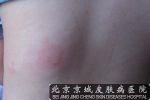 荨麻疹的危害大吗