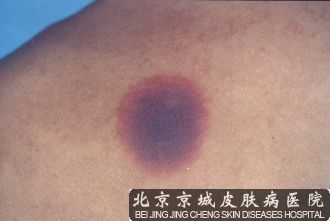 药疹的图片介绍