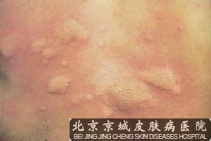 慢性荨麻疹