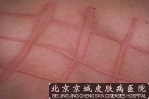 人工荨麻疹的偏方