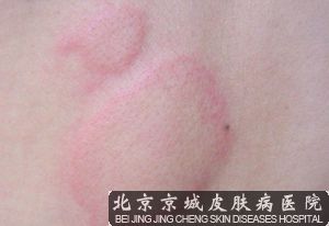 吃什么对荨麻疹有好处