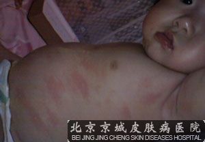 小儿荨麻疹的危害有多大