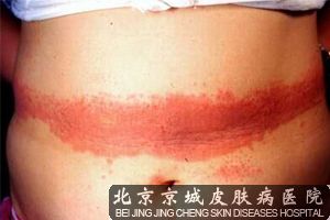 夏季患腰带性皮炎怎么办
