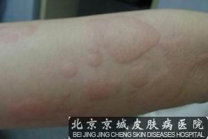 荨麻疹的护理措施