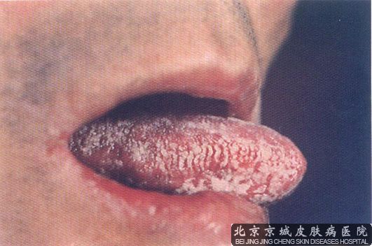 艾滋病初期症状图片