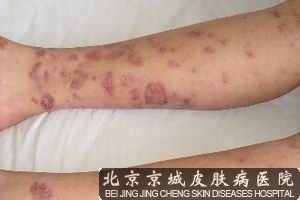 血管炎的症状有哪些
