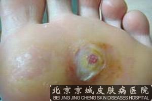 脚底长鸡眼怎么办