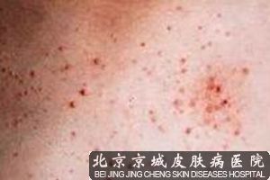 糠秕孢子菌毛囊炎有哪些症状表现