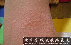 荨麻疹的危害有哪些