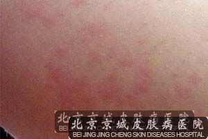 治疗皮炎较好医院
