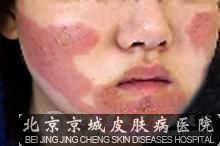 日光性皮炎怎么治