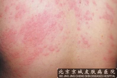 荨麻疹怎么治疗较