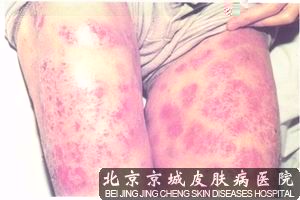 较好皮炎医院是哪家