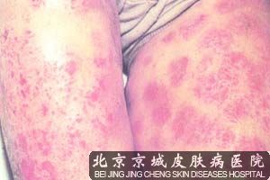 北京较好的皮炎医院是哪