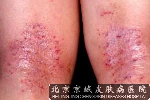 北京治疗皮炎好的医院
