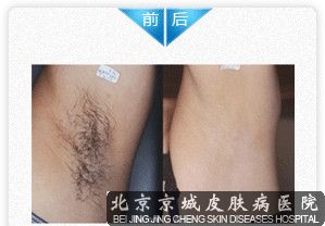飞顿冰点紧肤脱毛 首创 脱毛模式