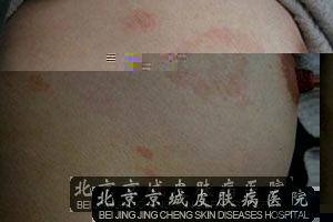 玫瑰糠疹传染吗