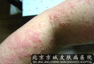 当心丘疹性荨麻疹