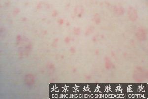 玫瑰糠疹怎么治疗