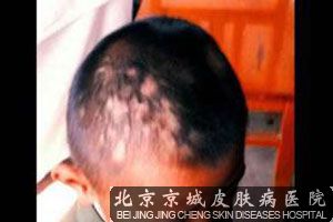 头癣疾病应该要如何进行防治