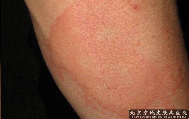 荨麻疹的危害是什么