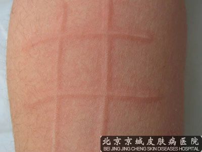 人工荨麻疹如何护理