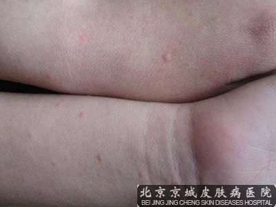 如何护理荨麻疹患者