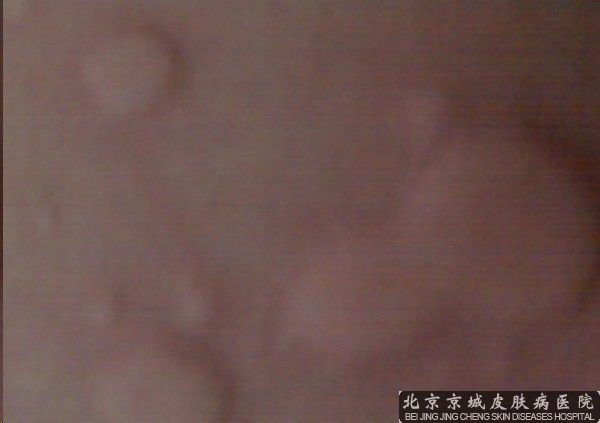 荨麻疹该怎样预防