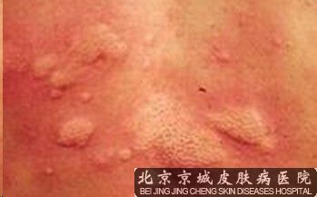 荨麻疹患者应该吃些什么