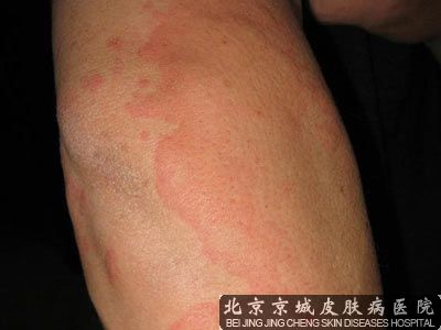 慢性荨麻疹的注意事项