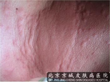 荨麻疹的护理
