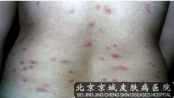 荨麻疹的症状是什么样的呢