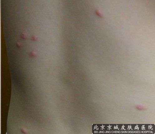 荨麻疹的护理方法是什么