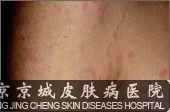 荨麻疹如何治疗