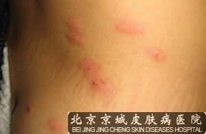 夏季荨麻疹预防措施有哪些