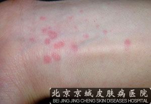 荨麻疹不能*的原因是什么