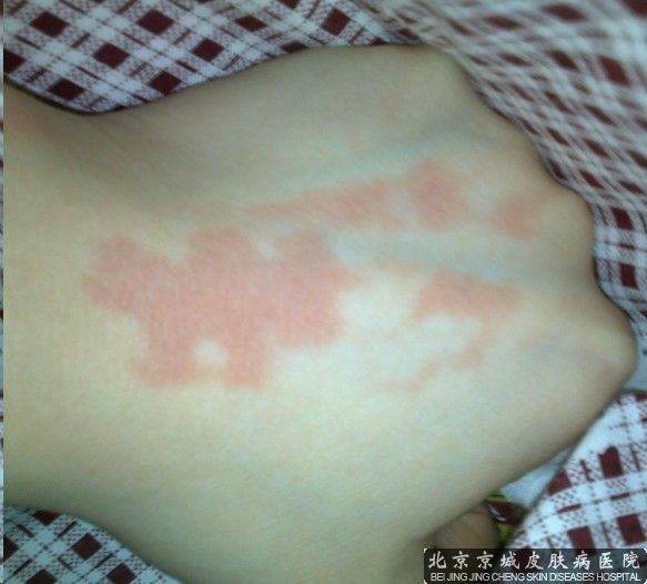荨麻疹的危害是什么