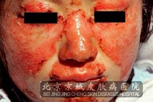 红斑狼疮可以吗