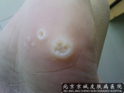 鸡眼去哪里治疗呢