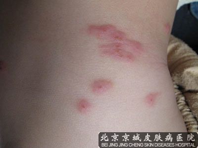 怎样预防丘疹性荨麻疹出现