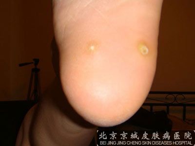 鸡眼针对病因如何治疗