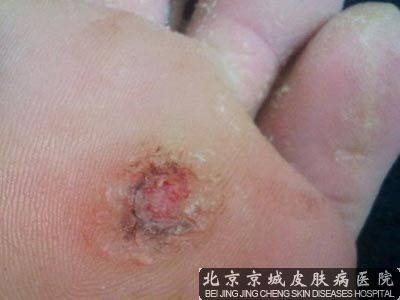 鸡眼如何治疗比较好