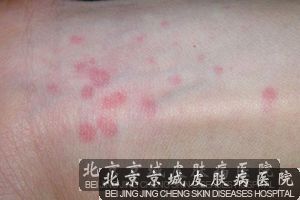 荨麻疹该如何护理